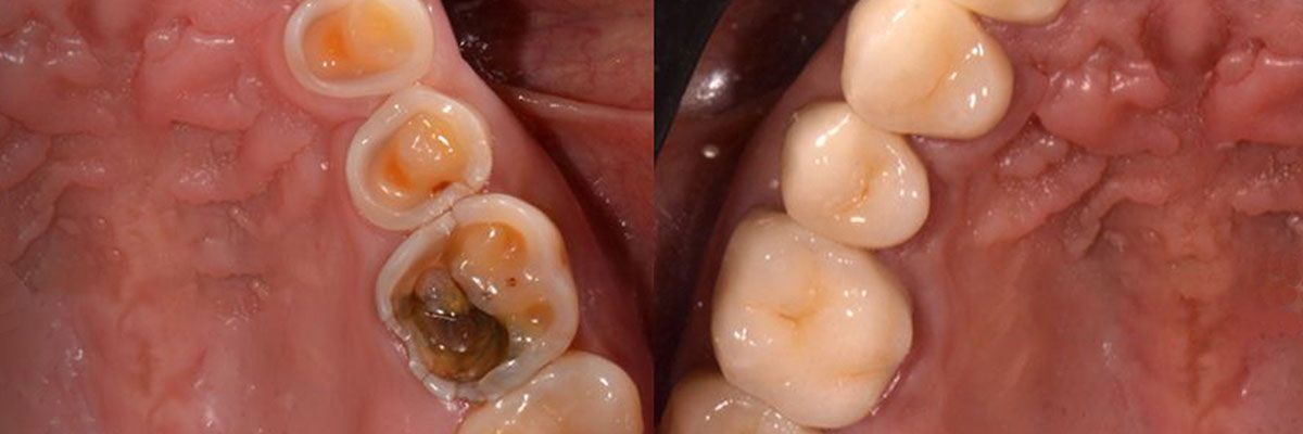 lesiones-cervicales-no-cariosas