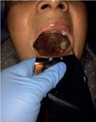 Mucormicosis