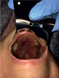 Mucormicosis