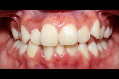 Hipomineralización incisivo molar