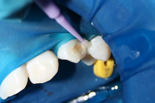 Hipomineralización incisivo Hipomineralización incisivo