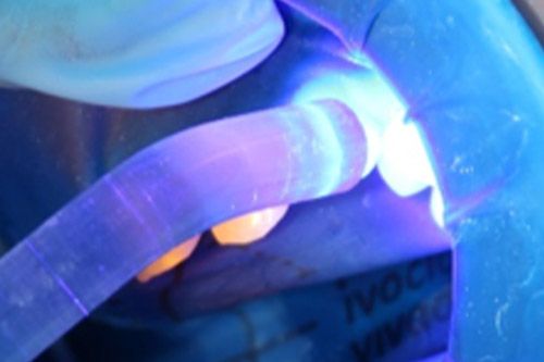 Hipomineralización incisivo Hipomineralización incisivo