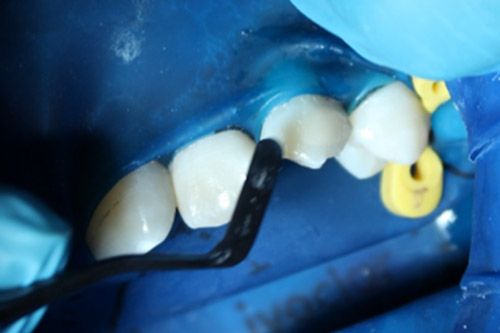 Hipomineralización incisivo Hipomineralización incisivo