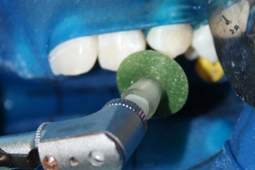 Hipomineralización incisivo Hipomineralización incisivo