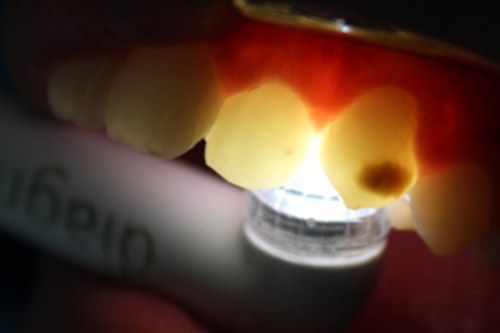 Hipomineralización incisivo molar Hipomineralización incisivo molar