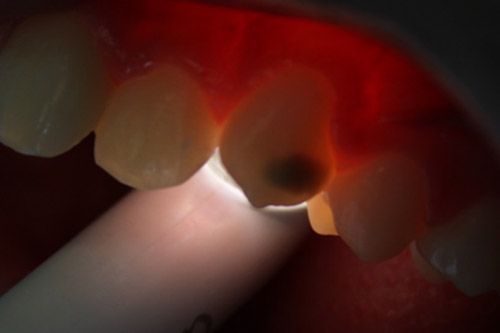 Hipomineralización incisivo molar Hipomineralización incisivo molar