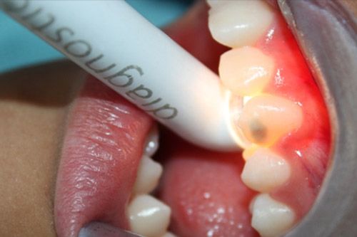 Hipomineralización incisivo molar Hipomineralización incisivo molar