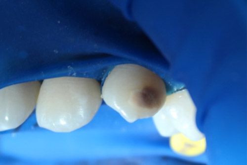Hipomineralización incisivo molar