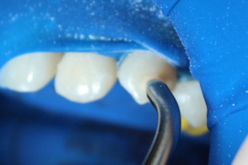 Hipomineralización incisivo Hipomineralización incisivo