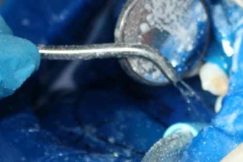 Hipomineralización incisivo Hipomineralización incisivo