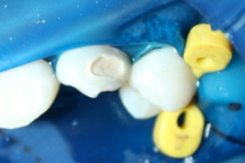 Hipomineralización incisivo Hipomineralización incisivo