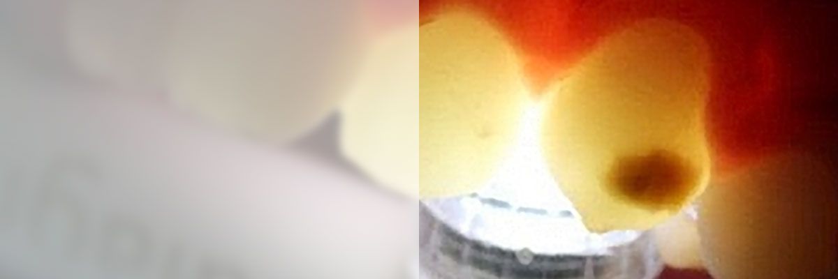 ICON en Hipomineralización incisivo molar