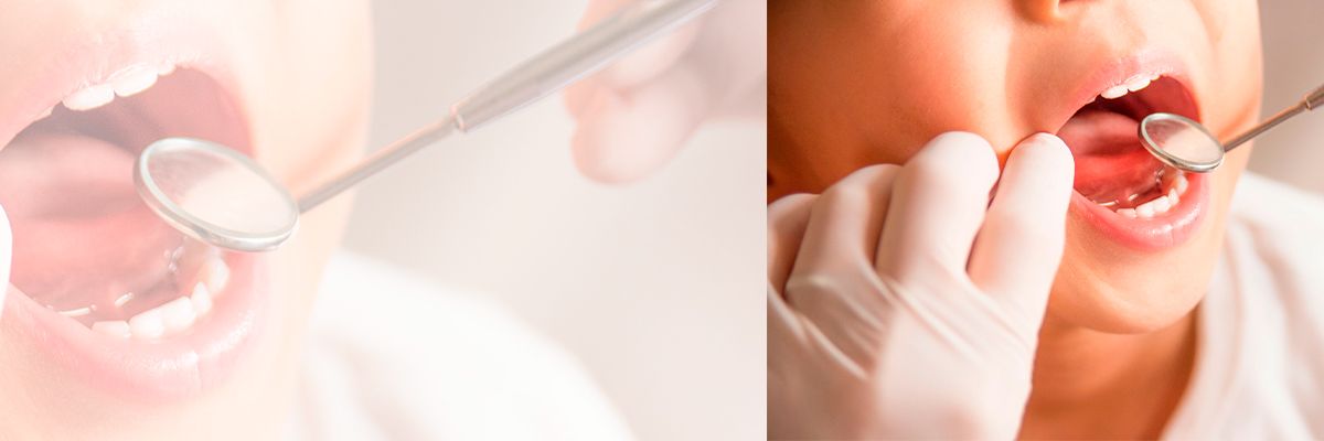 Tratamiento de lesiones cariosas proximales superficiales sobre molares primarios con infiltración de resina y barniz fluorado contra solamente barniz fluorado: eficacia después de 1 año