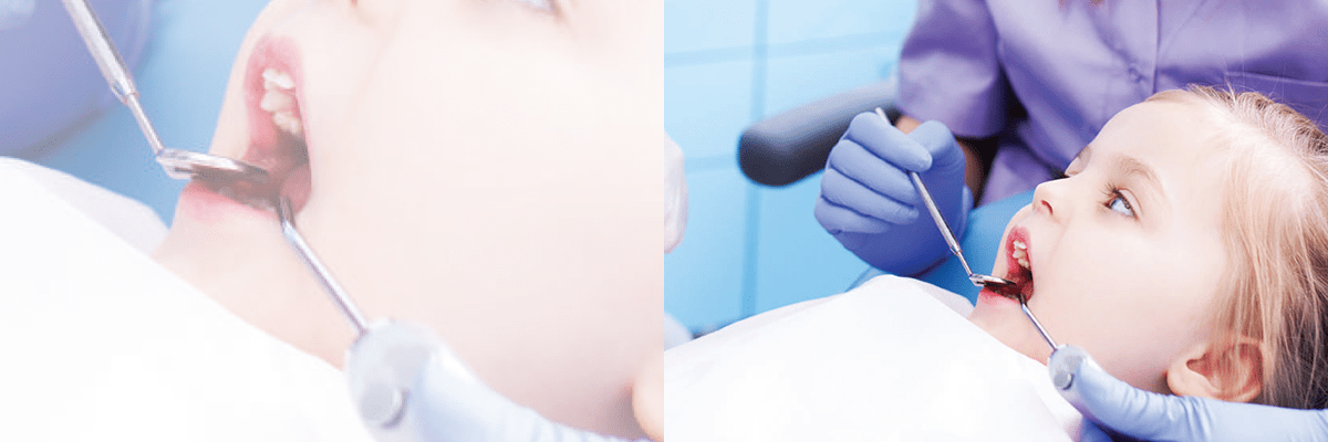Abordaje mínimamente invasivo en lesiones blanquecinas no cavitadas en dientes primarios