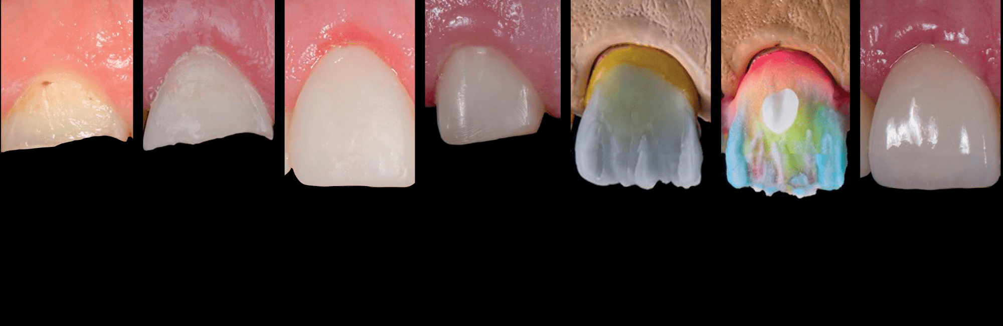 Rehabilitación oral minimamente adhesiva en un caso de erosión dental severa